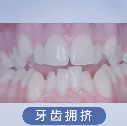 牙齿拥挤